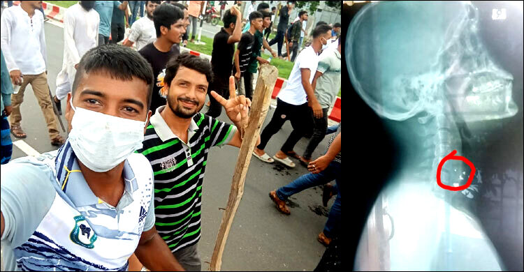 ২২টি ছররা গুলি শরীরে নিয়েও বেঁচে আছেন জুলাই যুদ্ধের বীর আলাউদ্দিন